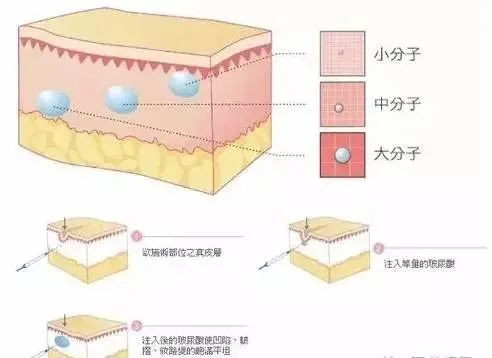 微整形注射需要注意的要点有哪些？丨科普篇