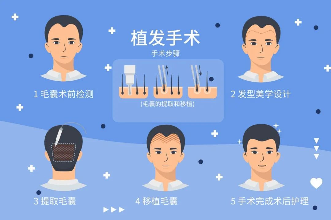 都来看看，植发之后，他怎么样了?