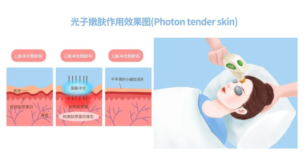 解决毛孔粗大推荐光子嫩肤+果酸治疗的王炸组合!还可试试这些方法