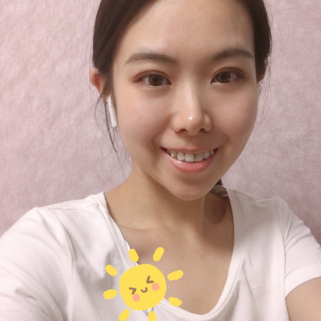 下巴打了溶解酶,恢复原来,边短了有点不适应,下巴宽怎么改善啊?